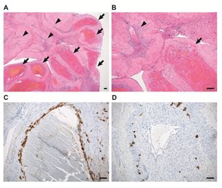 Clinical Complications Induced by Placental Site Subinvolution: Secondary-Type Hemorrhage after ...