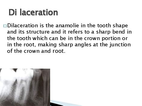 Shape Of Teeth Germination Tooth germination is a