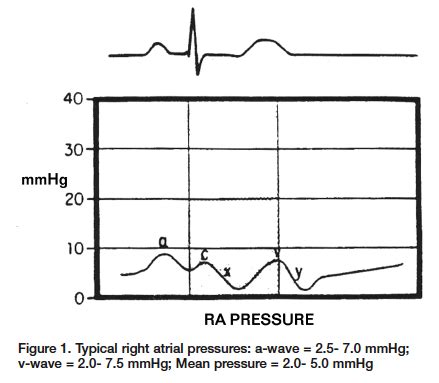 The ABCs of A to V: Right Atrial/ Left Atrial (PCW) Pressures