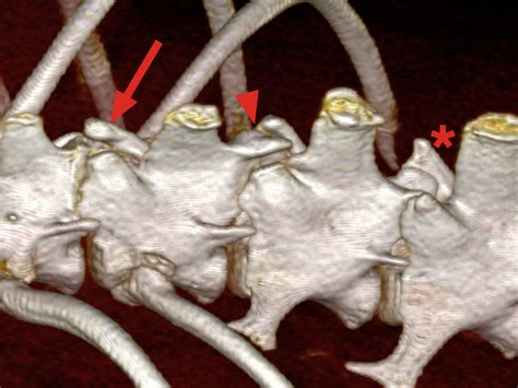 3D CT reconstruction of the thoracolumbar junction. The abnormally... | Download Scientific Diagram