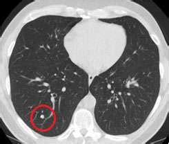 CT scans lower lung cancer deaths, according to study