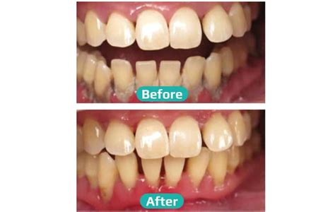 Best Wisdom Tooth Removal Treatment in Mumbai- ToothFix