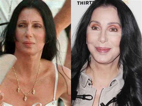 Cher plastic surgery 3