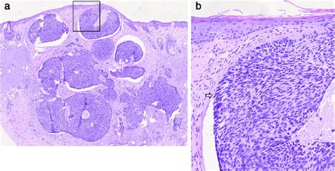 Histological overview showing a nodular BCC (nodulocystic variant) (a ...