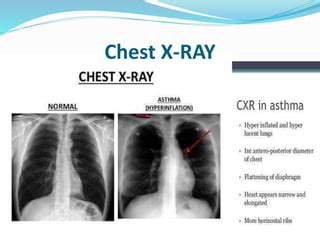 Clinical Features And Investigations Of Asthma | PPT