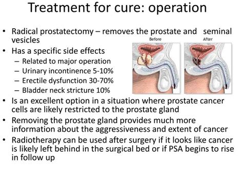 PPT - Everything you need to know about Prostate Radiotherapy During the talk or at end send ...