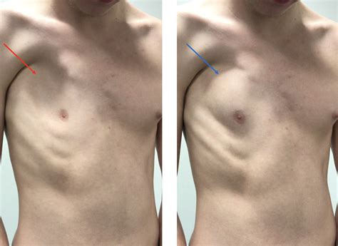 Chest wall lumps | Rib Injury Clinic