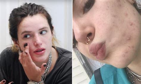 Yikes bella thorne s homemade acne scar treatment is slammed online – Artofit