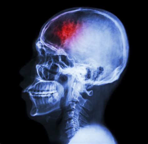 TBI 101: About Traumatic Brain Injury | BrainLine