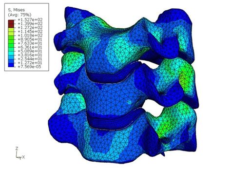 not only bridges: Why is the human spine considered a bad design from an engineering perspective?