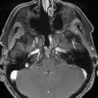 T1-weighted sagittal images showing an osteolytic lesion of the clivus... | Download Scientific ...