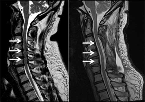 Spinal Stenosis - Sydney Neurospine