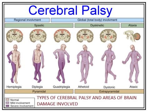 Cerebral Palsy Gait Pattern