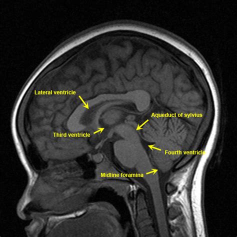 Hydrocephalus