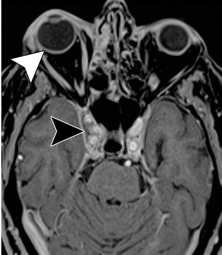 Cavernous Sinus Anatomy