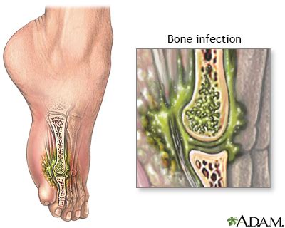 Osteomyelitis Information | Mount Sinai - New York