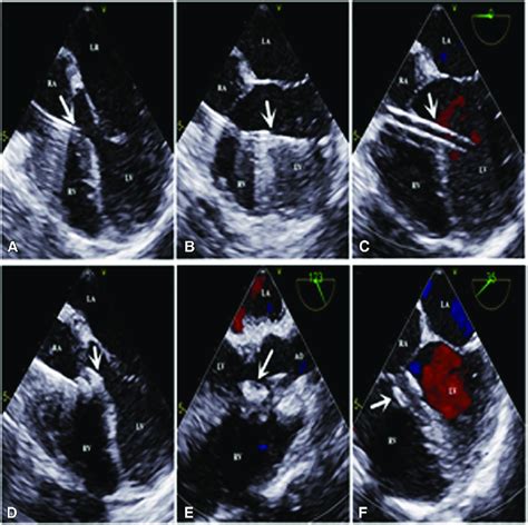 Operative steps. A, Hollow probe (arrow) passed across the defect. B ...