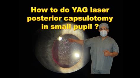 How to do YAG LASER Posterior Capsulotomy in Small pupil ? - YouTube