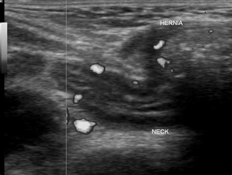 Indirect Inguinal Hernia Ultrasound