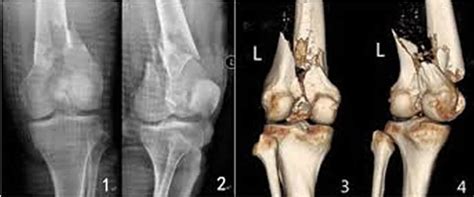 Broken femur types, causes, treatment, recovery time & complications