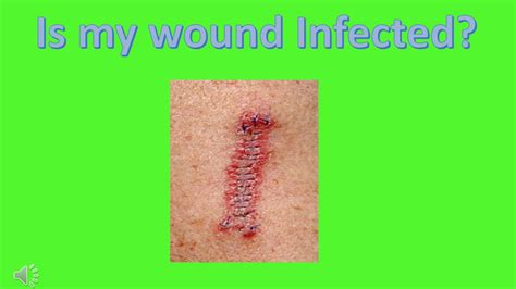 Infection : Is this wound infected - YouTube