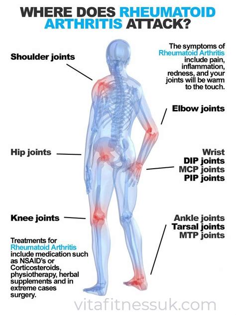 Do You Know About What is Rheumatoid Arthritis and its Signs and Symptoms? How It Will Affects ...