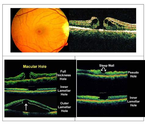 What is Optical Coherence Tomography (OCT)? Basic Interpretation ...