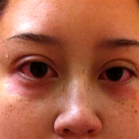 Chemosis Photos (1) » Eyelid Surgery: Cost, Photos, Rewiews, Q&A