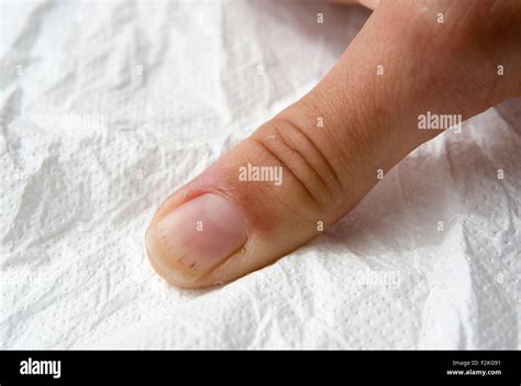 Splinter Haemorrhage : multiple splinter haemorrhages appear on a Stock Photo, Royalty Free ...