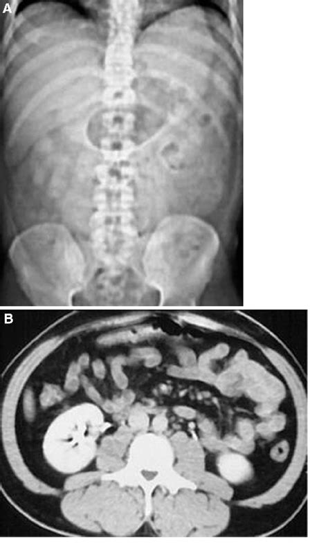 First stage of small bowel ischemia. A Digital radiography of patient... | Download Scientific ...