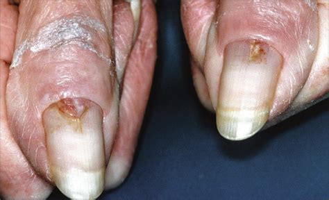 Gefitinib: A Cause of Pyogenic Granulomalike Lesions of the Nail ...