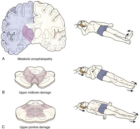 Neurologic Criteria for Death in Adults | Clinical Gate