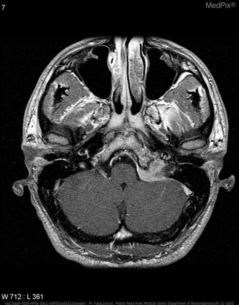 Jugular Foramen Mri