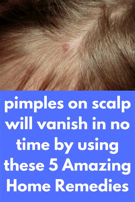 pimples on scalp will vanish in no time by using these 5 Amazing Home Remedies | Pimples on ...