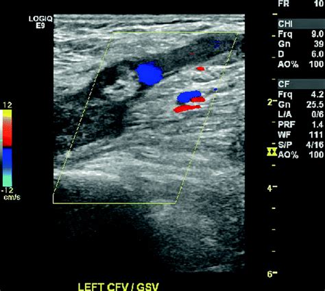 Non-thrombotic Abnormalities On Lower Extremity Venous, 54% OFF