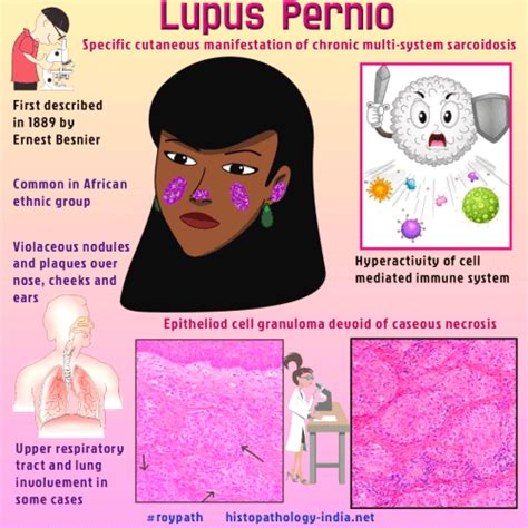 Pathology of Lupus Pernio (Cutaneous Sarcoidosis ) - Dr Sampurna Roy MD.