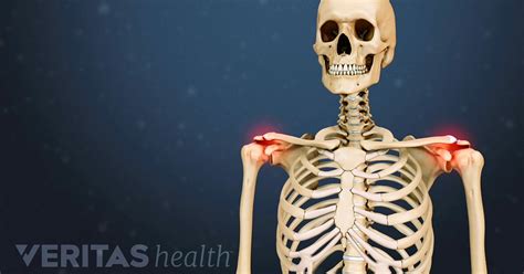 Acromioclavicular (AC) Joint Osteoarthritis Video