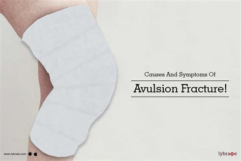 Causes And Symptoms Of Avulsion Fracture! - By Dr. Vivek A N | Lybrate