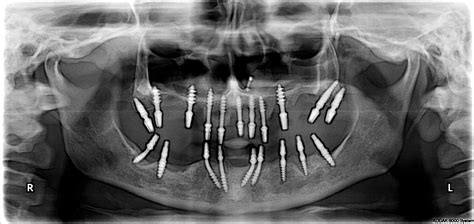 IMMEDIATE LOADING BASAL IMPLANTS – DENTAL IMPLANT SPECIALITY CENTRE