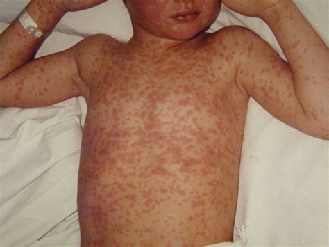 Measles: Signs, Symptoms, and Complications