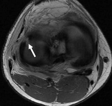 How to Read an MRI of a Radial Meniscus Tear | Sports Medicine Knee Specialist | Minnesota