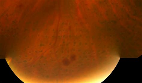 Retinal Laser Photocoagulation