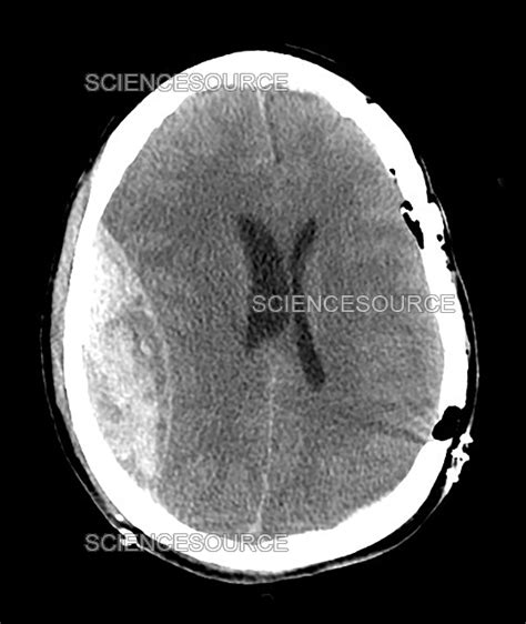 Photograph Epidural Hematoma Ct Scan Science Source Images | The Best ...