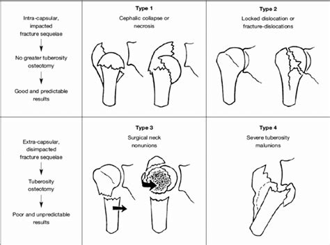 Proximal humerus fracture sequelae according to Boileau et al. [1 ...