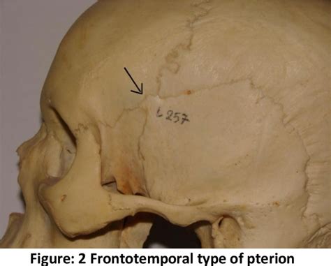 Figure 1 from Study of Pterion And Incidence Of Epipteric Bones In Dry Human Skulls Of Gujarat ...