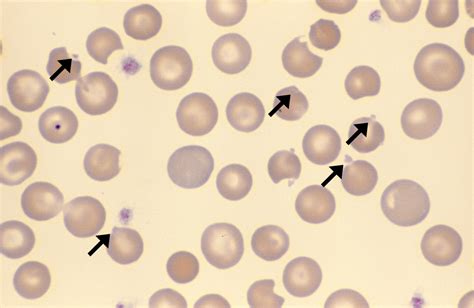 Decoding Heinz Bodies: Identifying the Anemia Types with Positive Heinz ...