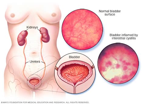 Interstitial cystitis Disease Reference Guide - Drugs.com