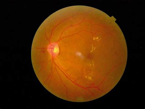 Clinically Significant Macular Edema Oct