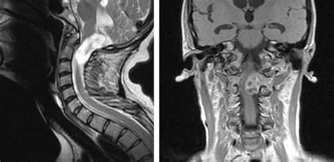 Cervicocranial syndrome definition, causes, symptoms, diagnosis & treatment