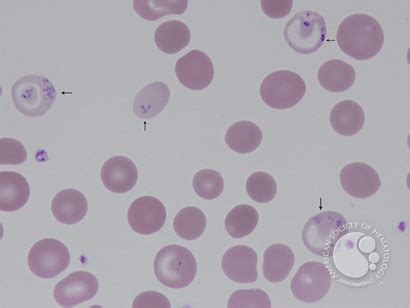 Siderocytes - 1.